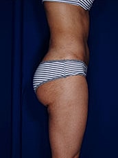 Brazilian Butt Lift Before & After