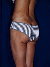 Brazilian Butt Lift Before & After