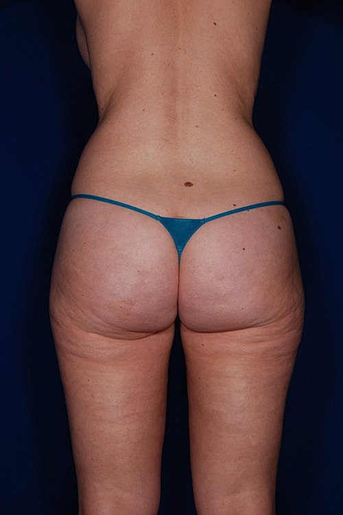 Brazilian Butt Lift Before & After
