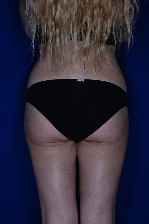Brazilian Butt Lift Before & After