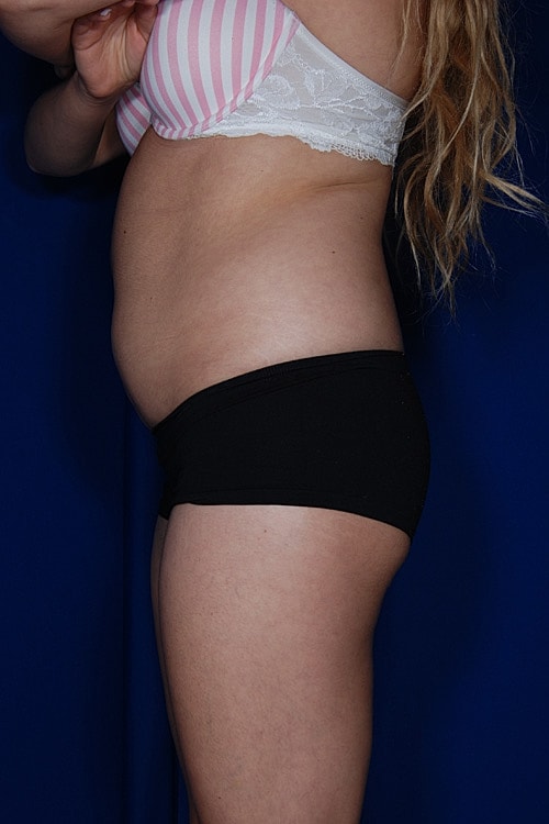 Brazilian Butt Lift Before & After