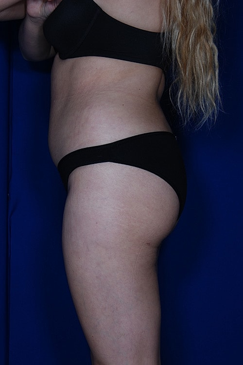 Brazilian Butt Lift Before & After