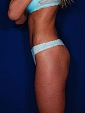 Brazilian Butt Lift Before & After