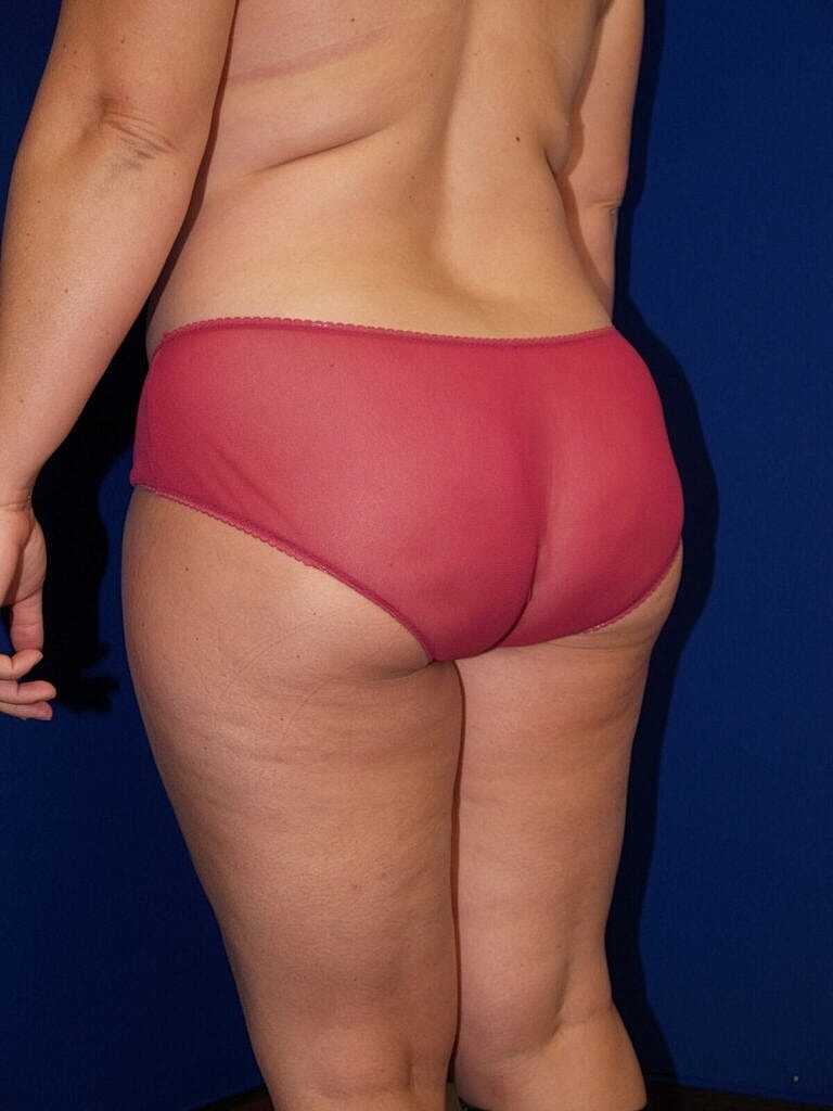 Brazilian Butt Lift Before & After