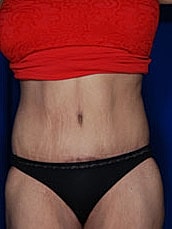 Post Weight Loss Surgery Before & After