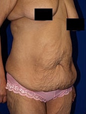 Post Weight Loss Surgery Before & After