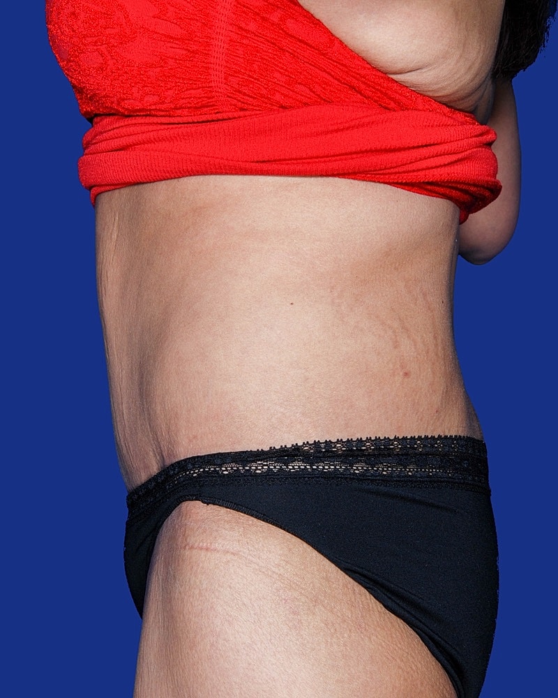 Post Weight Loss Surgery Before & After