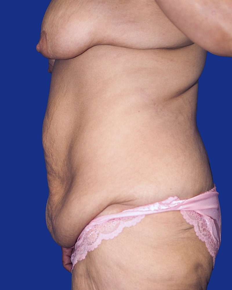 Post Weight Loss Surgery Before & After