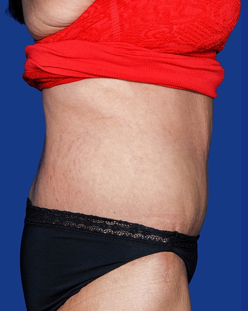 Post Weight Loss Surgery Before & After