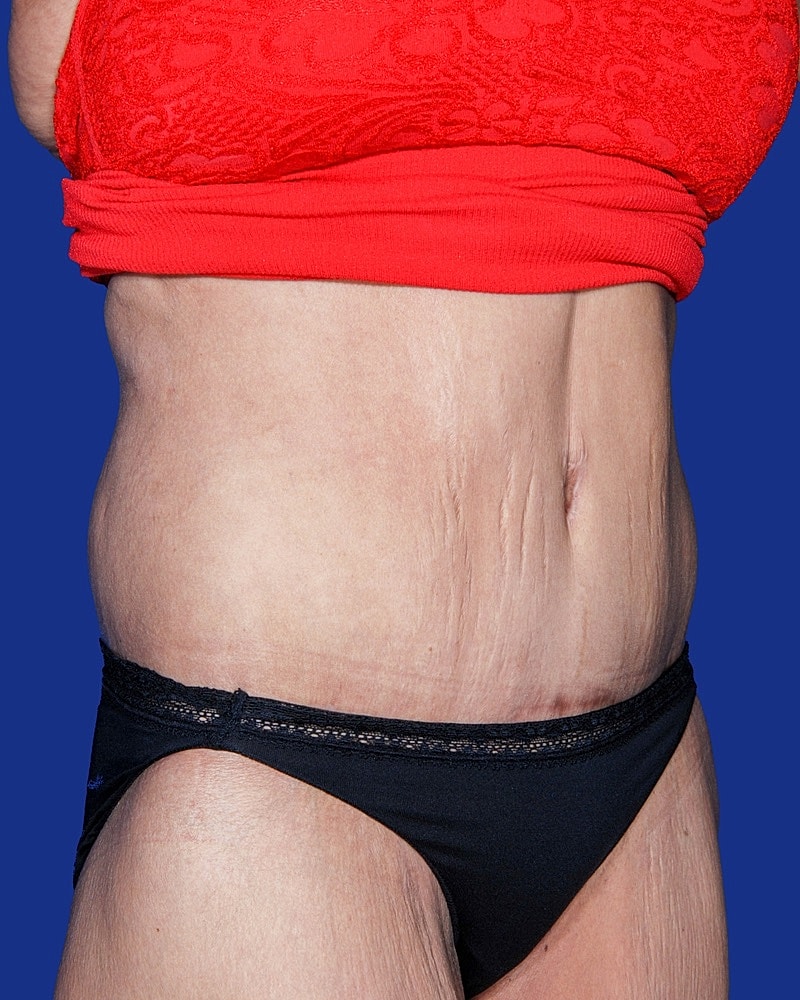 Post Weight Loss Surgery Before & After