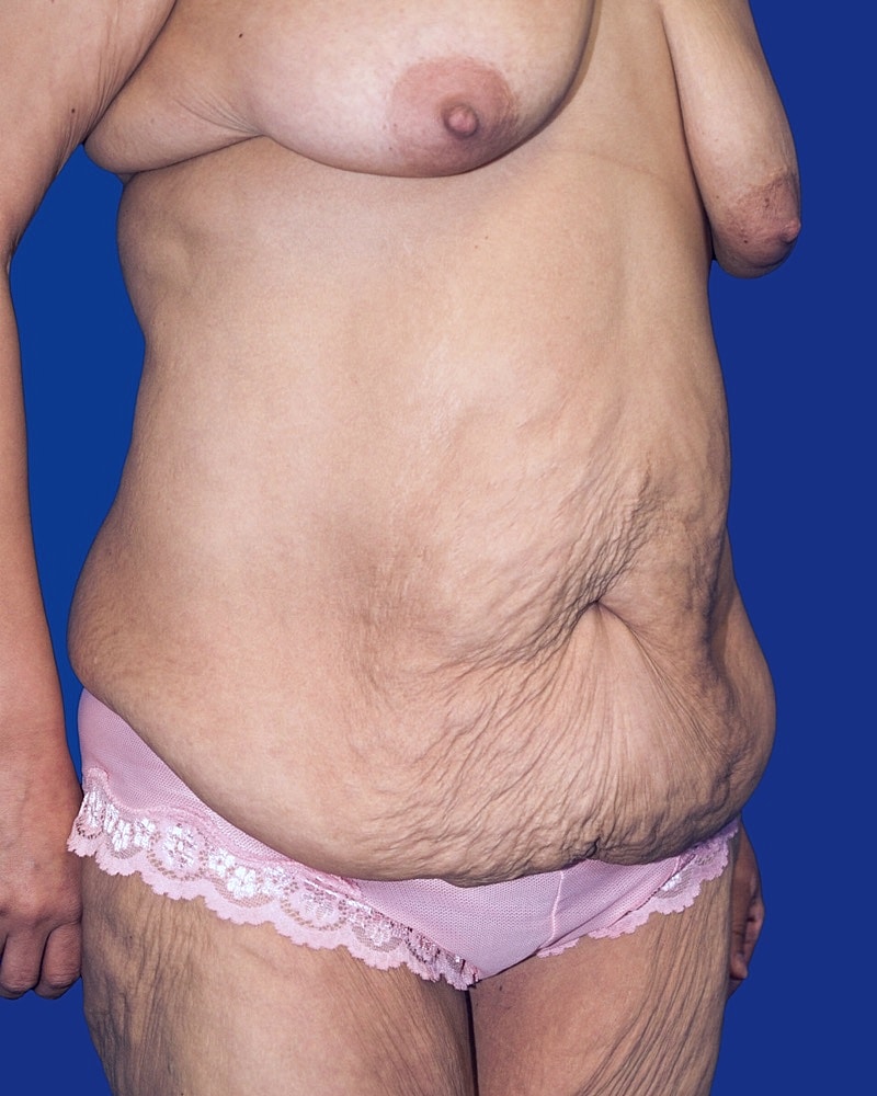 Post Weight Loss Surgery Before & After