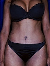 Post Weight Loss Surgery Before & After