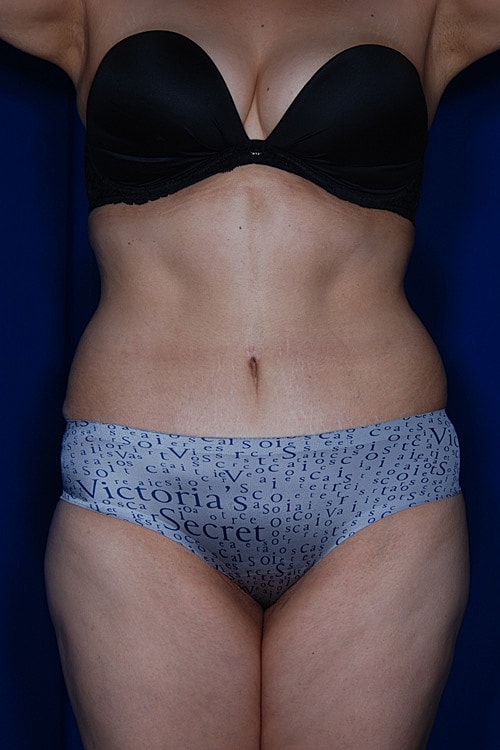 Post Weight Loss Surgery Before & After