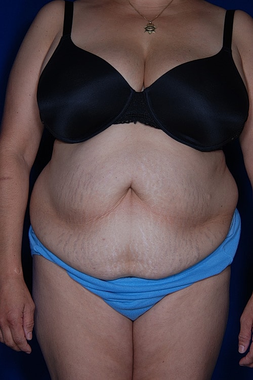 Post Weight Loss Surgery Before & After
