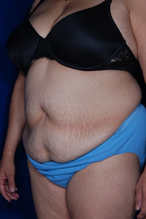 Post Weight Loss Surgery Before & After