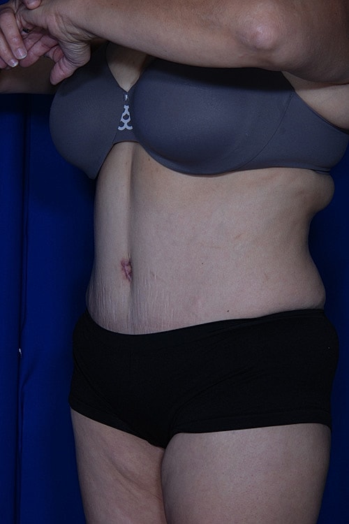 Post Weight Loss Surgery Before & After
