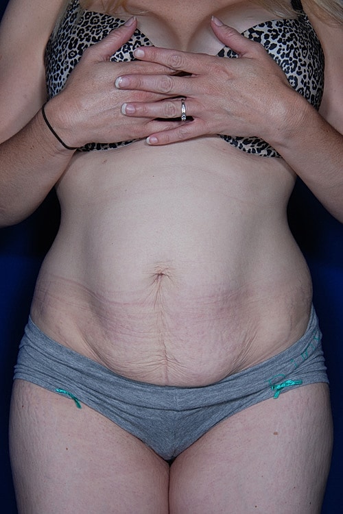 Post Weight Loss Surgery Before & After