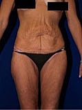Post Weight Loss Surgery Before & After