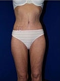 Post Weight Loss Surgery Before & After