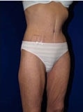 Post Weight Loss Surgery Before & After