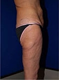 Post Weight Loss Surgery Before & After