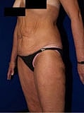 Post Weight Loss Surgery Before & After
