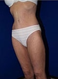 Post Weight Loss Surgery Before & After