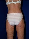 Post Weight Loss Surgery Before & After