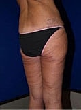 Post Weight Loss Surgery Before & After
