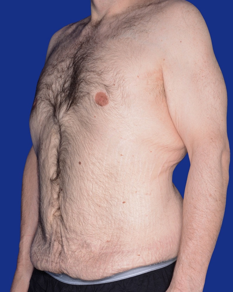 Post Weight Loss Surgery Before & After
