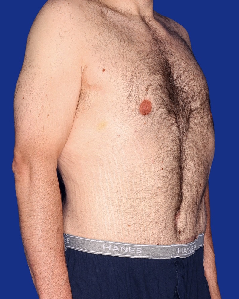 Post Weight Loss Surgery Before & After