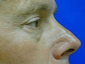 Male Eyelid Surgery Before & After