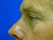 Male Eyelid Surgery Before & After