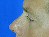 Male Eyelid Surgery Before & After