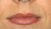 Dermal Fillers Before & After