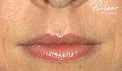 Dermal Fillers Before & After