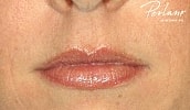 Dermal Fillers Before & After