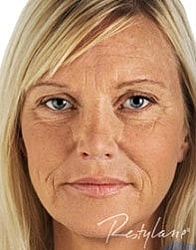 Dermal Fillers Before & After