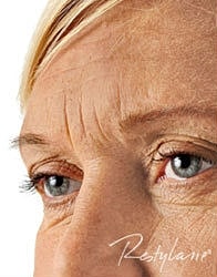 Dermal Fillers Before & After