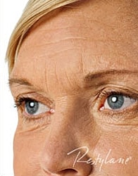 Dermal Fillers Before & After