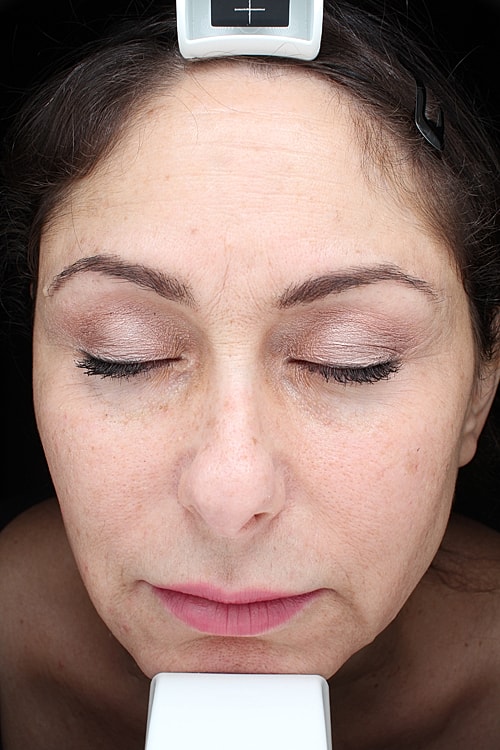 Laser Pigmentation Treatment Before & After