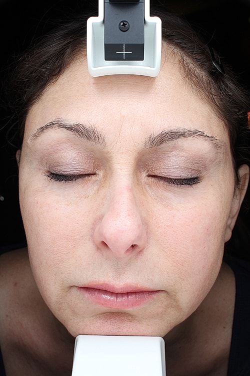 Laser Pigmentation Treatment Before & After