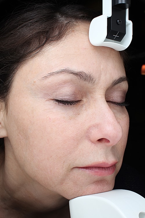 Laser Pigmentation Treatment Before & After