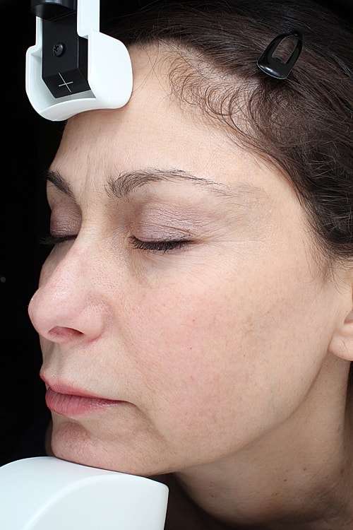 Laser Pigmentation Treatment Before & After