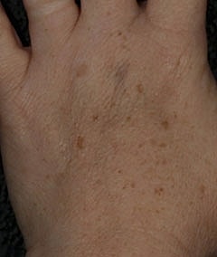 Laser Pigmentation Treatment Before & After