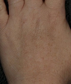 Laser Pigmentation Treatment Before & After