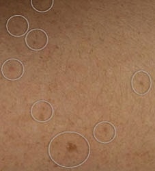 Laser Pigmentation Treatment Before & After
