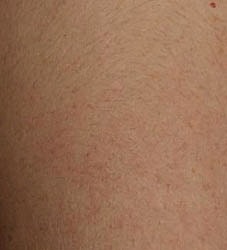 Laser Pigmentation Treatment Before & After