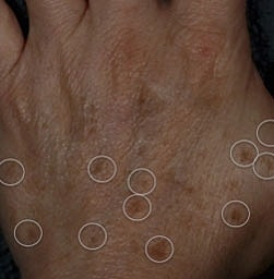 Laser Pigmentation Treatment Before & After