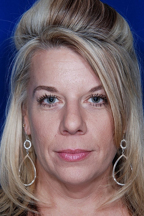 Facelift Before & After